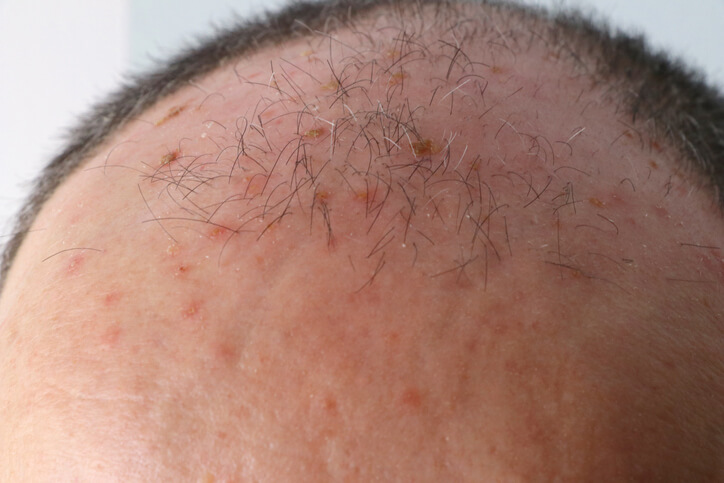 Close up of balding forehead with blemishes
