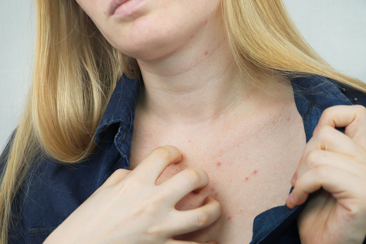 Close up of young woman scratching chest with red blemishes