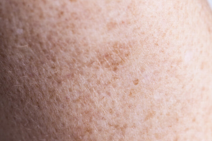 Skin with pigmentation marks