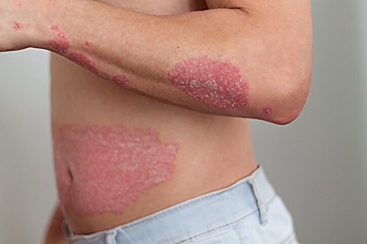 Skin with psoriasis marks