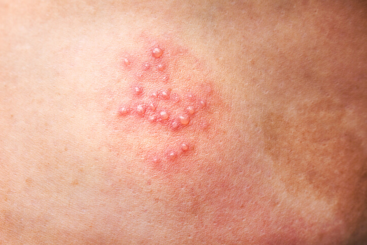 Close up of blistering rash