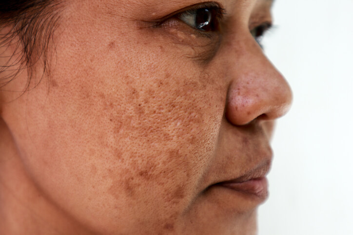 Close up of dark pigmentation on woman's face