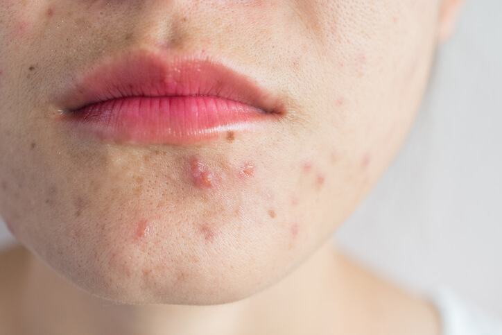 Close up of acne on girls face