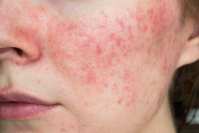 Close up of face with rosacea blemishes