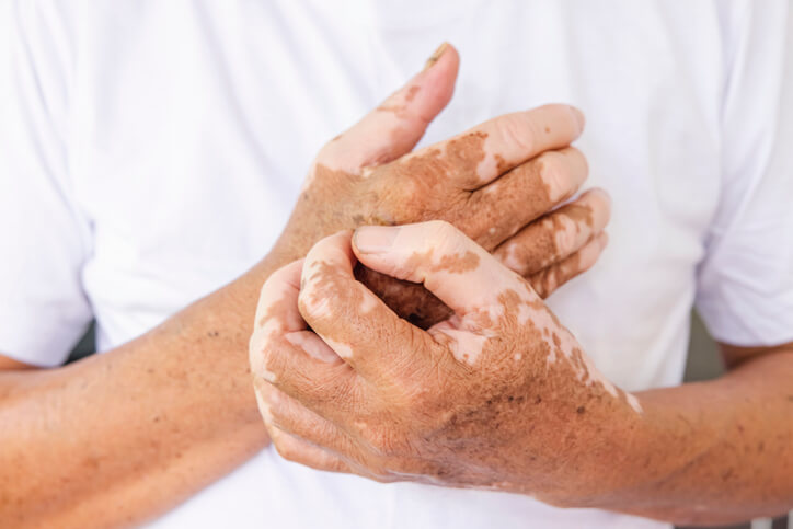 Close up of hands with vitiligo