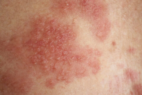 Skin Conditions | Desert Valley Dermatology