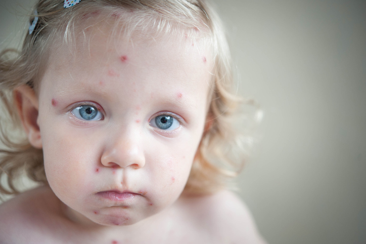 Girl with chickenpox