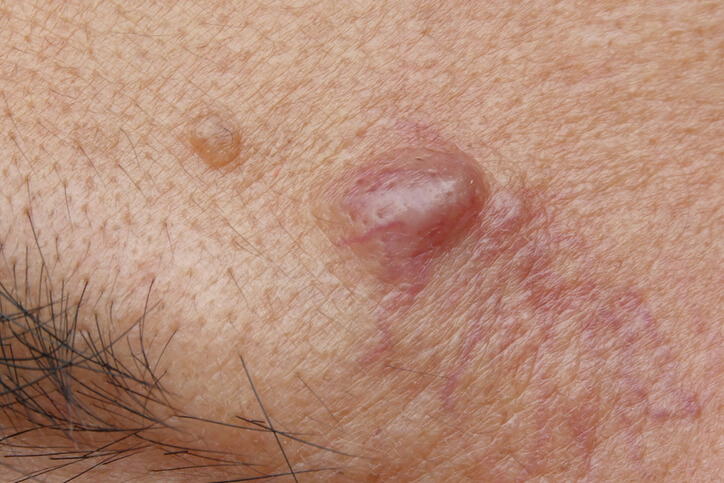 Close up of cyst