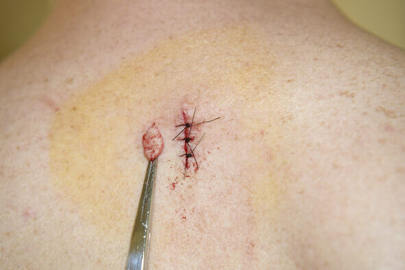 Pre-cancerous tissue removed from a man's back; iodine and fresh stitches visible.