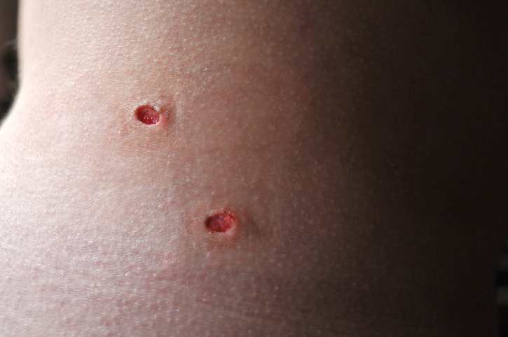 Horizontal image of two punch biopsy wounds. The wounds have been cleaned and the blood has begun to clot. The skin samples will be tested for melanoma. The photograph was taken with low light, which creates a shallow depth of field, but the wounds themselves are in sharp focus.