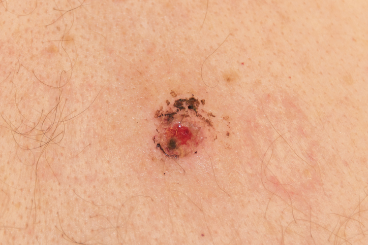Skin after removing a mole for biopsy testing