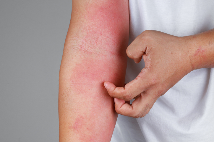 Person scratching red, blotchy skin on arm