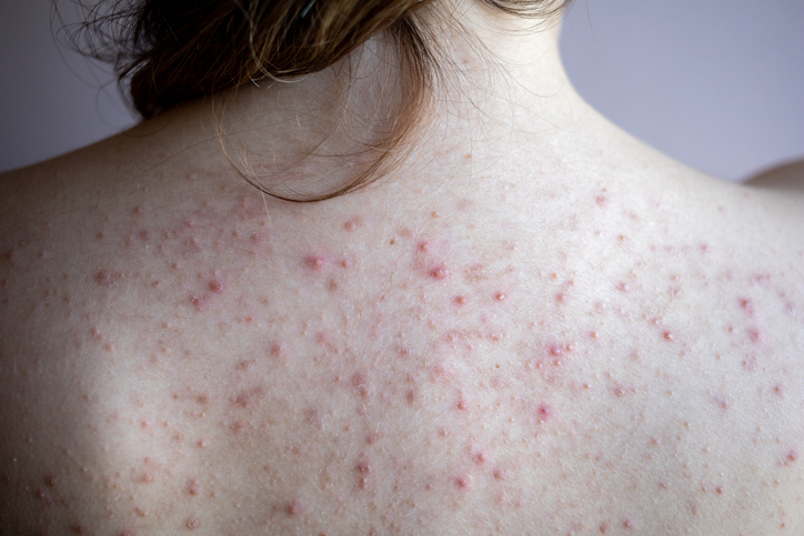 woman's back with acne